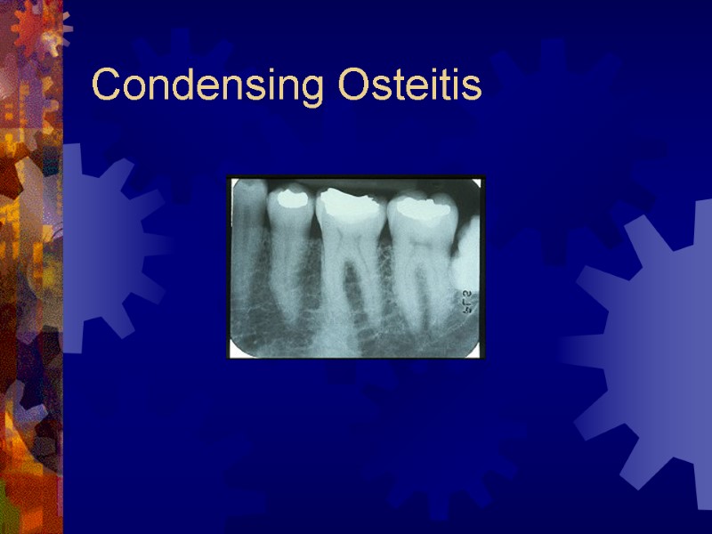 Condensing Osteitis